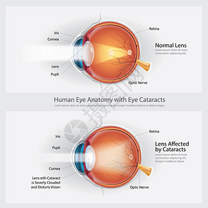 视网膜中央静脉白内障视觉失常和正常眼视力插画