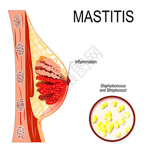 巴托林腺囊肿乳腺炎乳房炎症脓肿形成插画