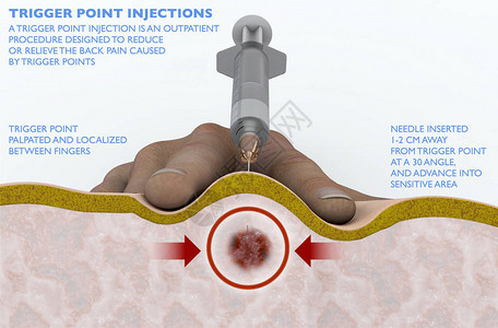 敏感肌海报触发点注射是一种门诊手术设计图片