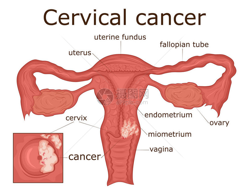 女生殖系统疾病宫颈癌的例证图片