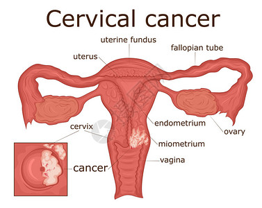 性腺女生殖系统疾病宫颈癌的例证插画