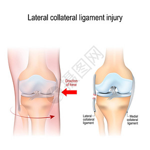 腓侧副韧带损伤关节解剖用于生物医学科学和教育用图片