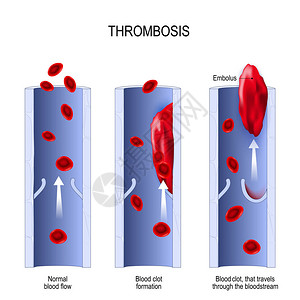 血栓栓塞从正常血流到血凝块形成插画
