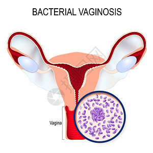 vulvovaginitis健康微生物高清图片