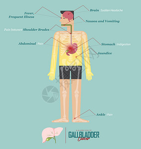 胆囊癌标志癌症高清图片