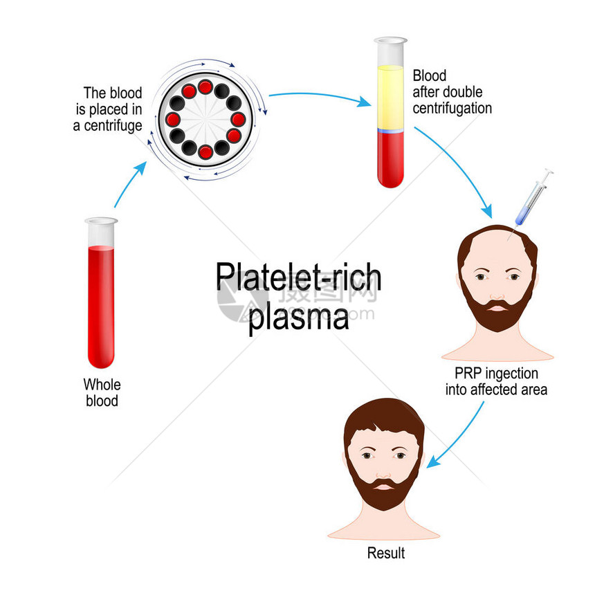 富含血小板的血浆PRP头发疗法医疗程序毛发修复外科医生采集患者血液图片