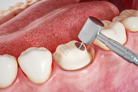 显微根管治疗三维牙齿打桩场景设计图片