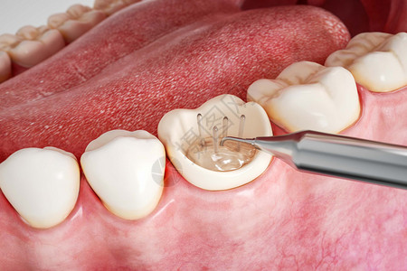 牙齿根管治疗三维牙齿修复根充场景设计图片