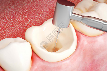 牛蒡根三维牙齿根管治疗场景设计图片