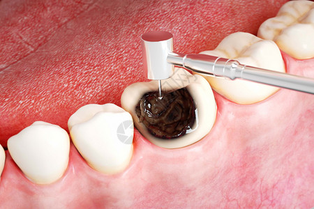 显微根管治疗三维蛀牙打磨场景设计图片
