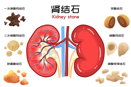 世界肾脏日肾结石图解科普插画图片