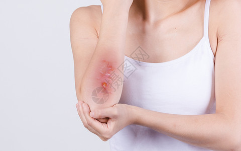 伤口消毒药水手肘疼痛的女人设计图片