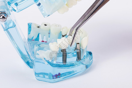 牙齿模型护牙牙合架高清图片