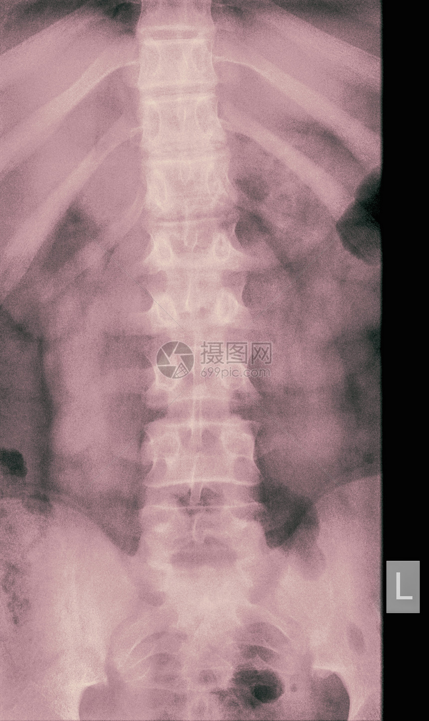 14岁男性左二椎体压缩性骨折X线，正视图图片