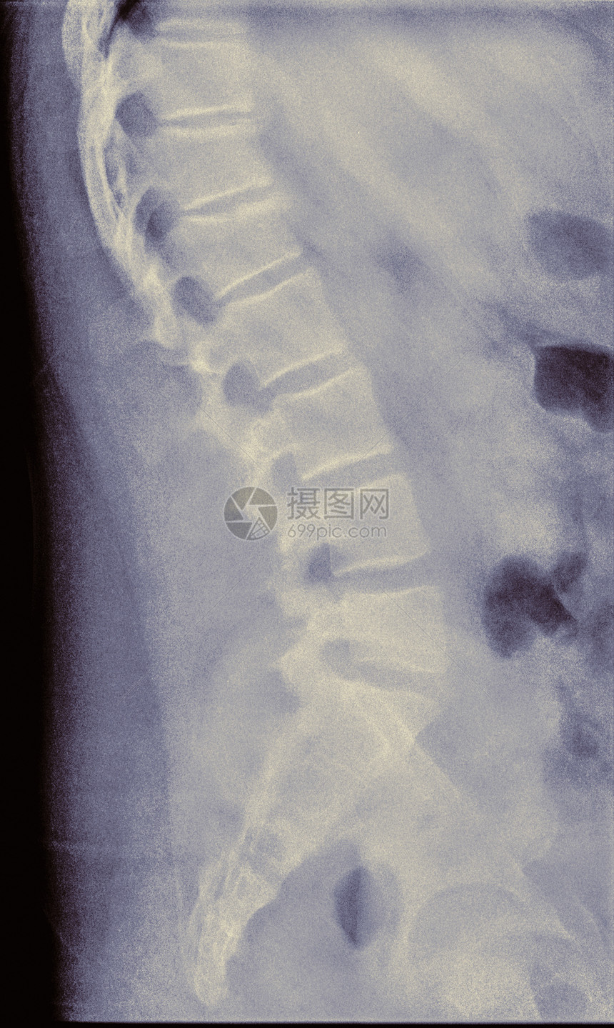 14岁男性左二椎体侧视压缩性骨折的X线表现图片