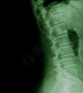 77岁患者腰椎x线侧视图背景图片