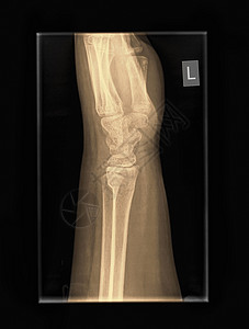 9岁男性桡骨远端尺骨骨折患者手腕部X线表现背景