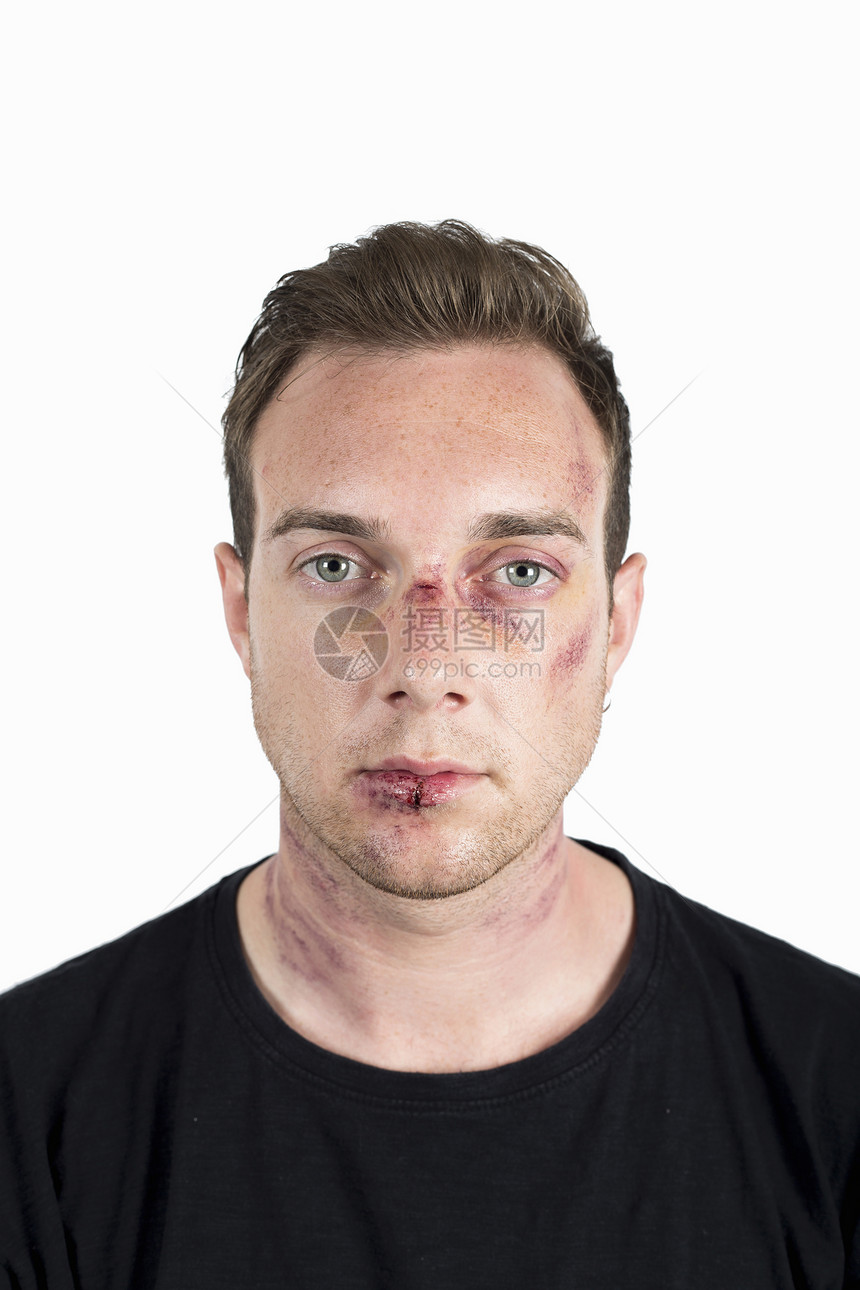 年轻男性家庭暴力受害者面部受伤照片图片