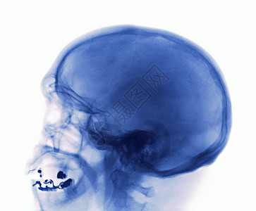 头骨X光检查背景图片