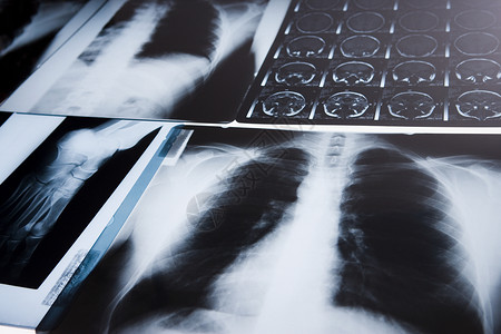 胸部X光和MRI扫描背景图片