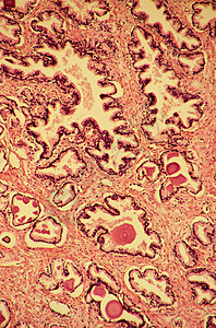 显微镜下的前列腺图片