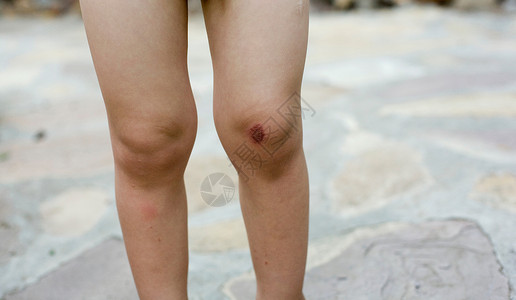 膝盖磕伤图片