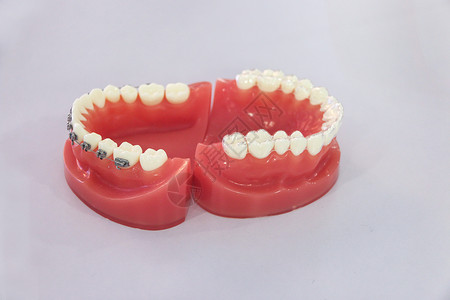 牙齿模型隐形支架高清图片