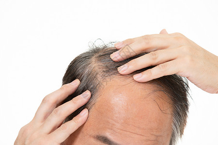 脱发不治疗秃顶的中年人背景