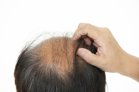 脱发不治疗秃头的中年人背景