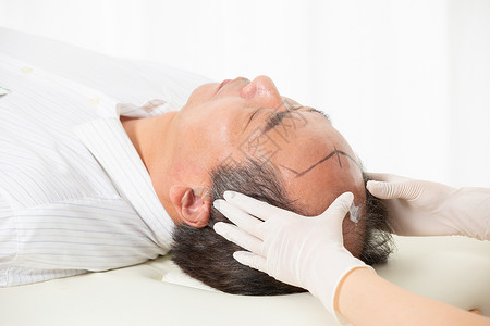 防脱发中年男性脱发治疗背景