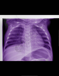 X光胸腔拍摄图片