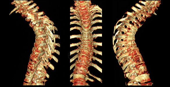 骨质疏松心肺脊椎和骨质疏松症的CT扫描图片