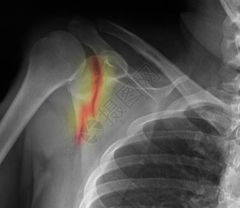肩胛骨骨折的肩部X线图片