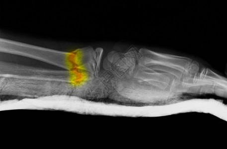 切裂前臂骨折X光图片