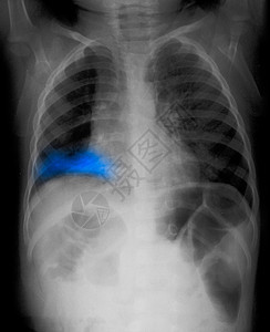 右肺患儿的X射线图片