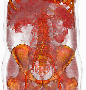3DCT静脉激素立板扫描低动能图片