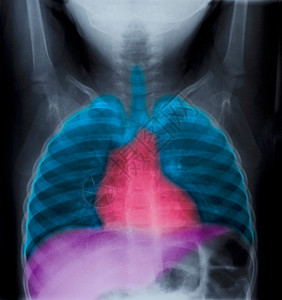 2岁女孩的正常胸部X光片图片
