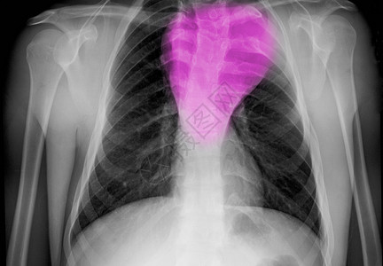 胸部的X光片图片