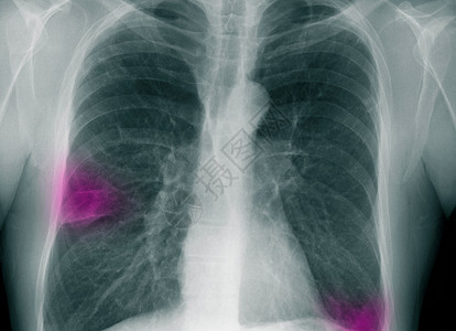 人体切片X光渗透到右肺背景