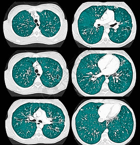 胸部轴心CT扫描囊纤维化背景图片