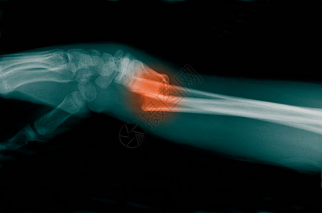 前臂骨折X光高清图片