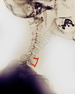 颈脊椎X光检查图片