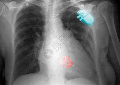 胸腔X光检查图片