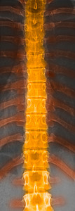胸脊骨正常X光图片