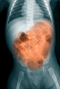 婴儿腹部X光片图片