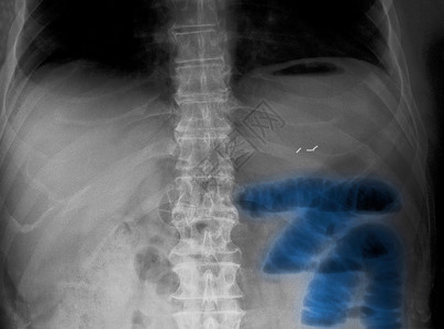 腹部X线小肠梗阻图片