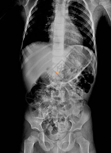 儿童腹部X光片吞食金属珠图片