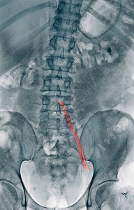 腹部X光射线图片