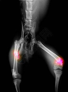 X光片骨折的大腿图片