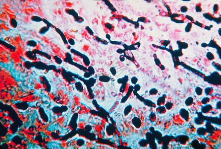 食道肌肉中Candida显微摄影图高清图片